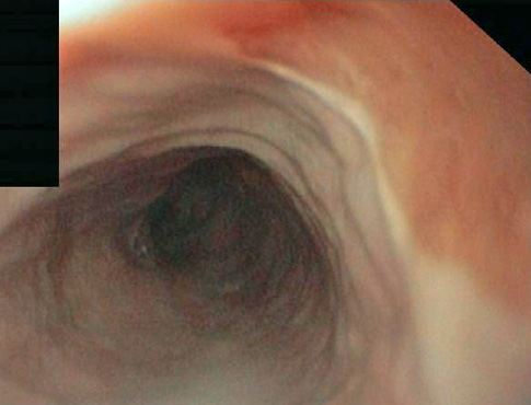 Heterotopia gástrica en esófago cervical (“inlet patch”): una entidad infradiagnosticada.