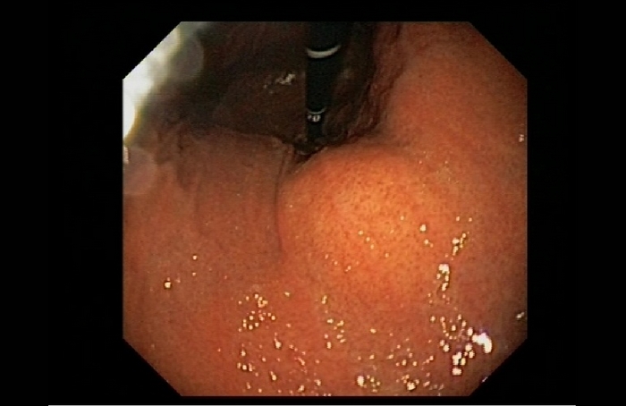 Infarto idiopático del omento menor: diagnóstico diferencial de masa dolorosa en epigastrio