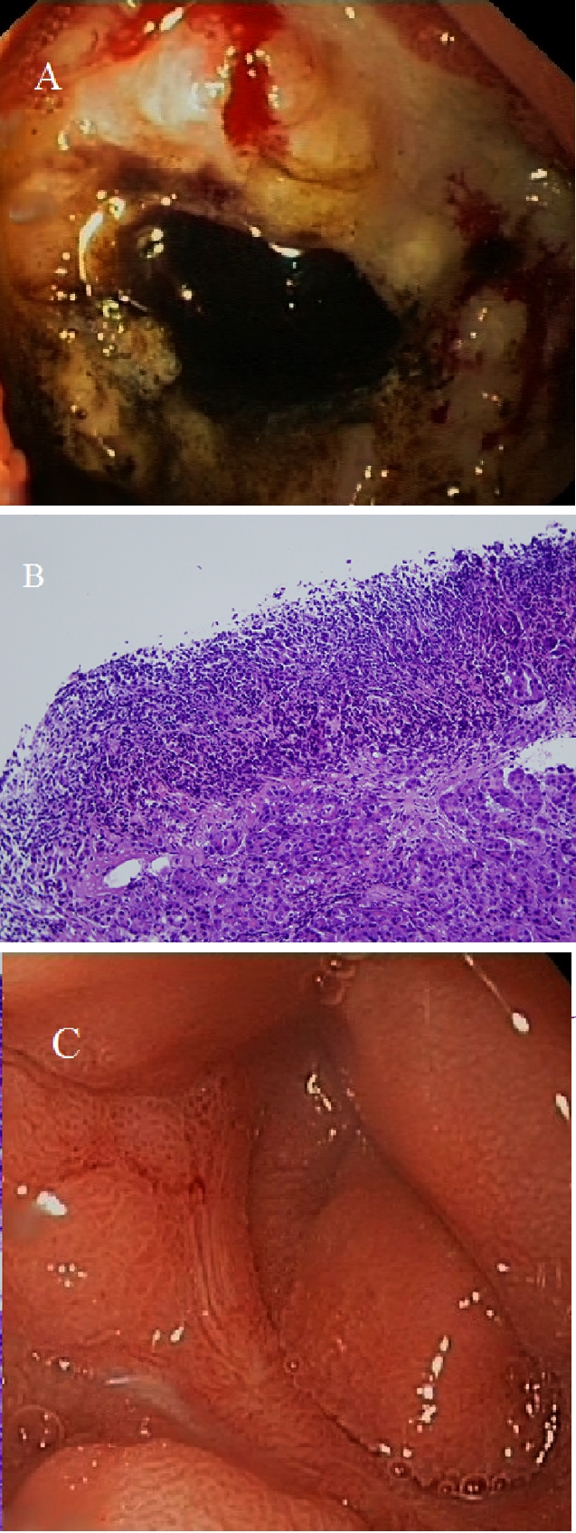 Úlcera péptica duodenal simulando cáncer