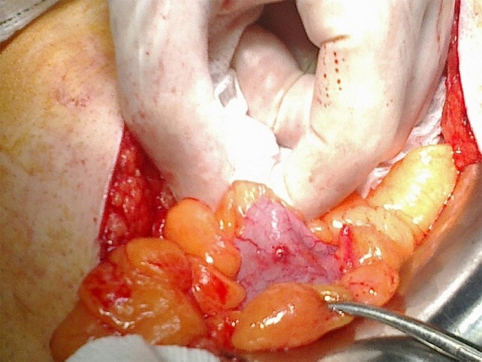 Perforación colónica con la toma de biopsias en la colitis ulcerosa de larga evolución.